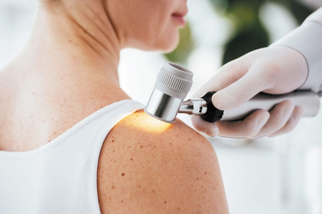 Skin Cancer