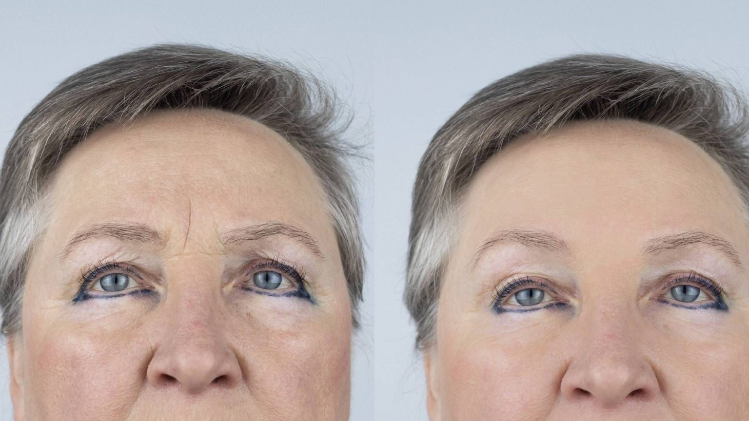 Botox
