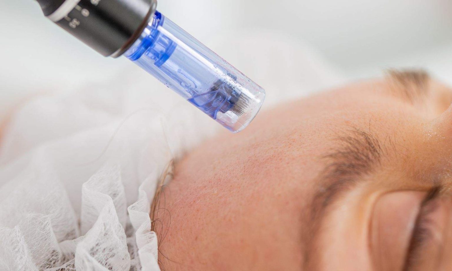 What To Expect From a Microneedling Treatment Microneedling Treatment