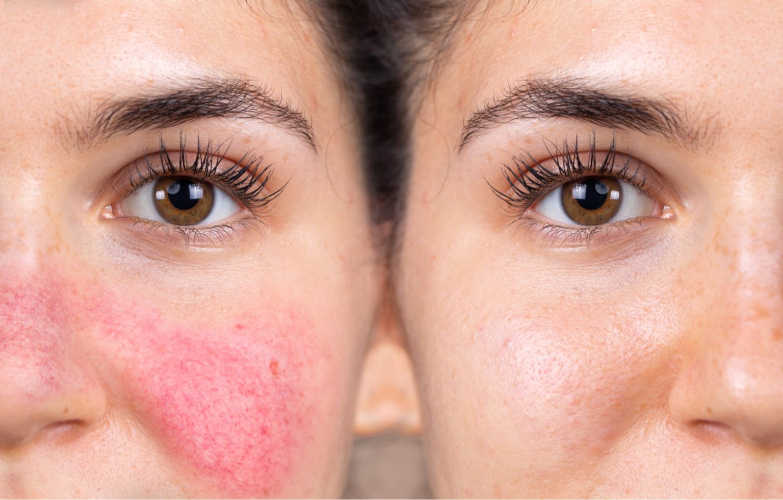 Rosacea Management and Skin Sensitivity Solutions Rosacea Management