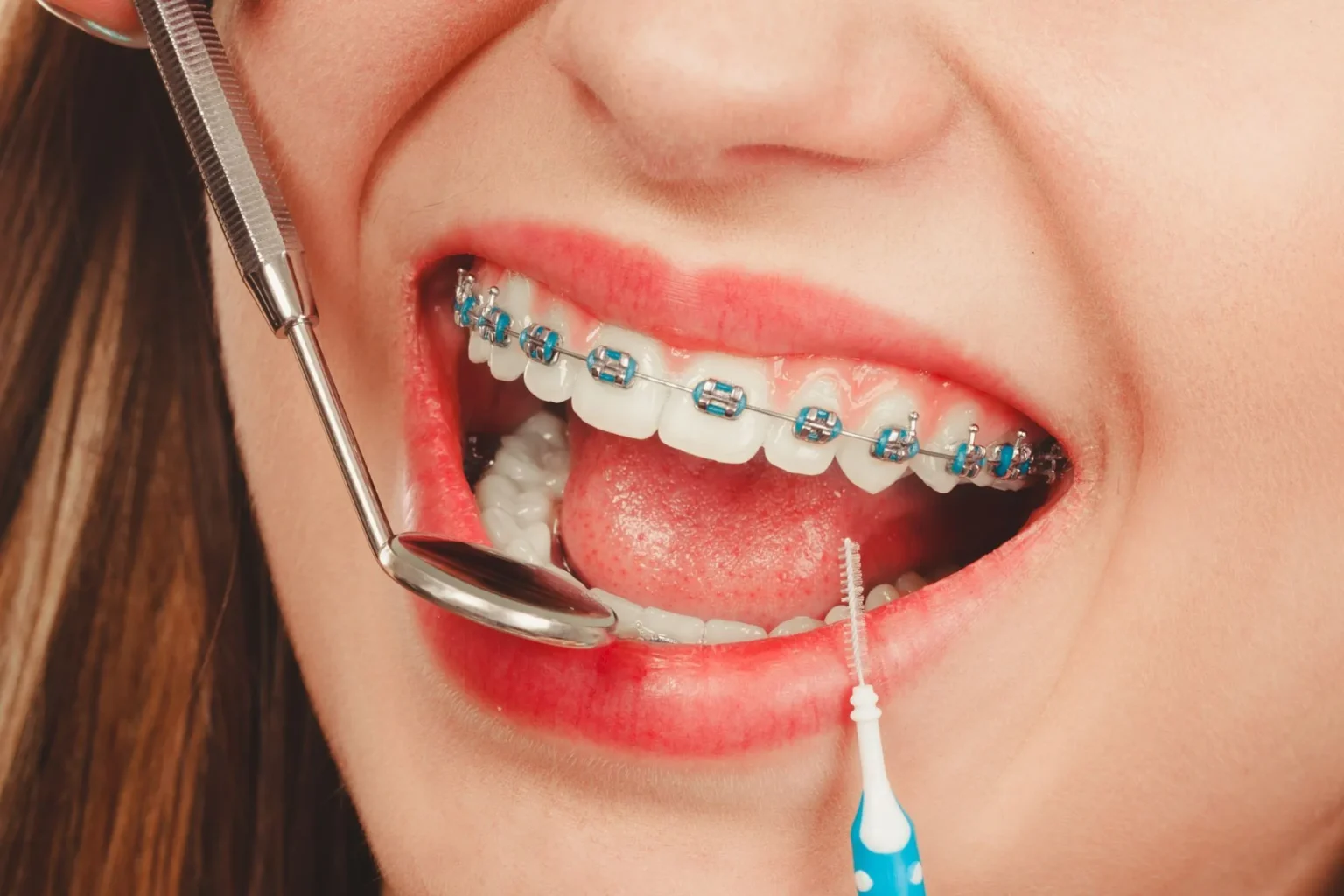 Types of Braces