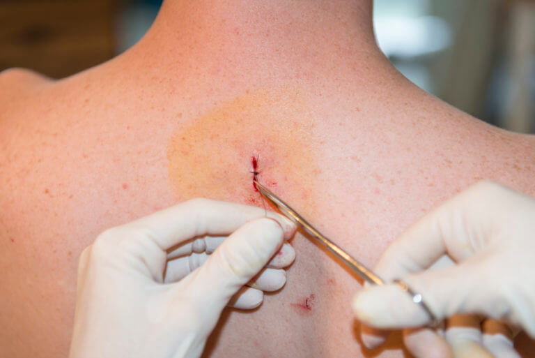What You Should Know About Basal Cell Carcinoma Treatment Basal Cell Carcinoma Treatment