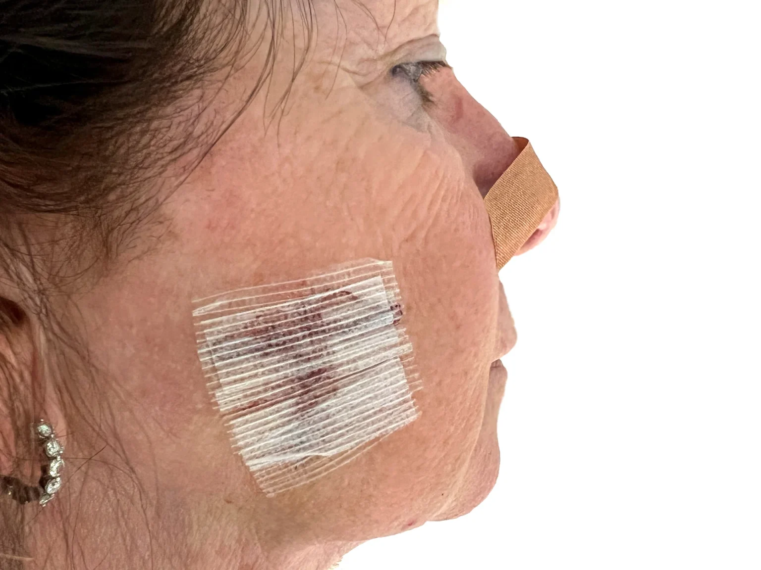 Why Mohs Surgery Is Used for Skin Cancer Removal Mohs Surgery