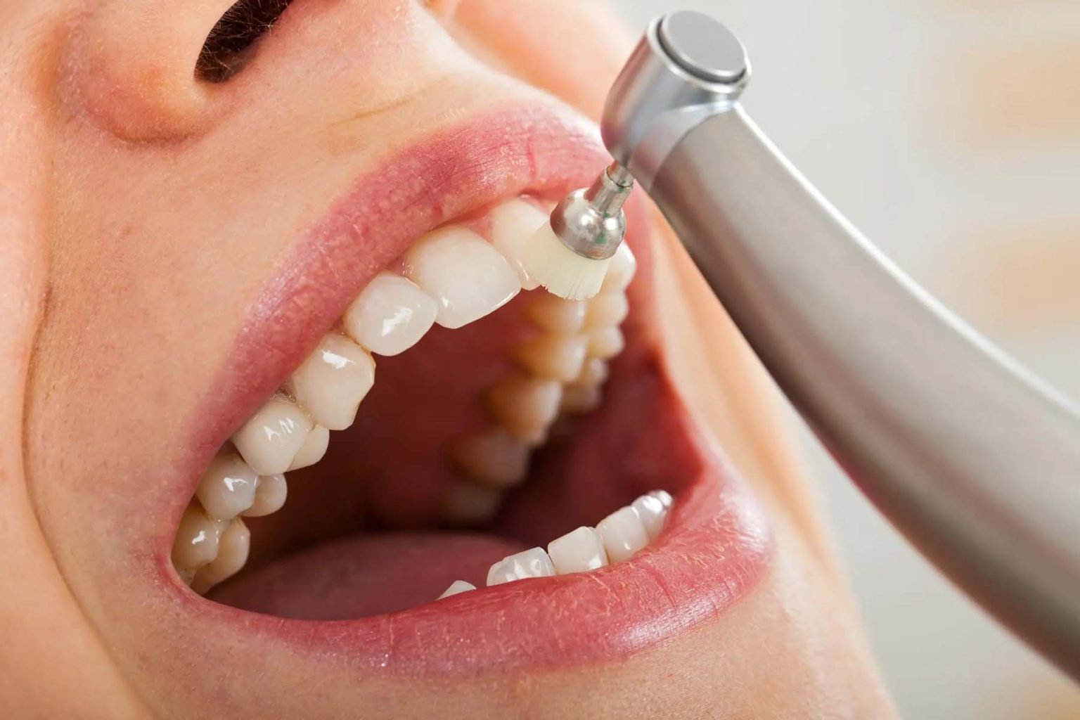 What You Should Know About Professional Teeth Cleaning Professional Teeth Cleaning