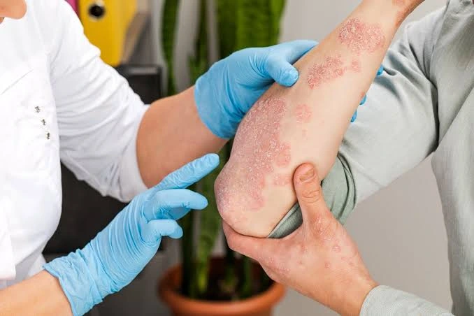 Exploring Psoriasis Treatment Options Psoriasis Treatment Options