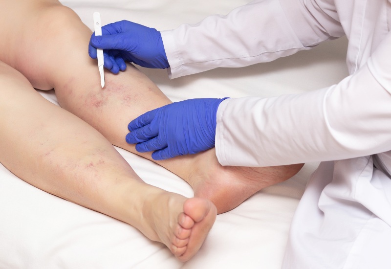 Signs It’s Time To Visit a Vascular Surgeon Visit a Vascular Surgeon