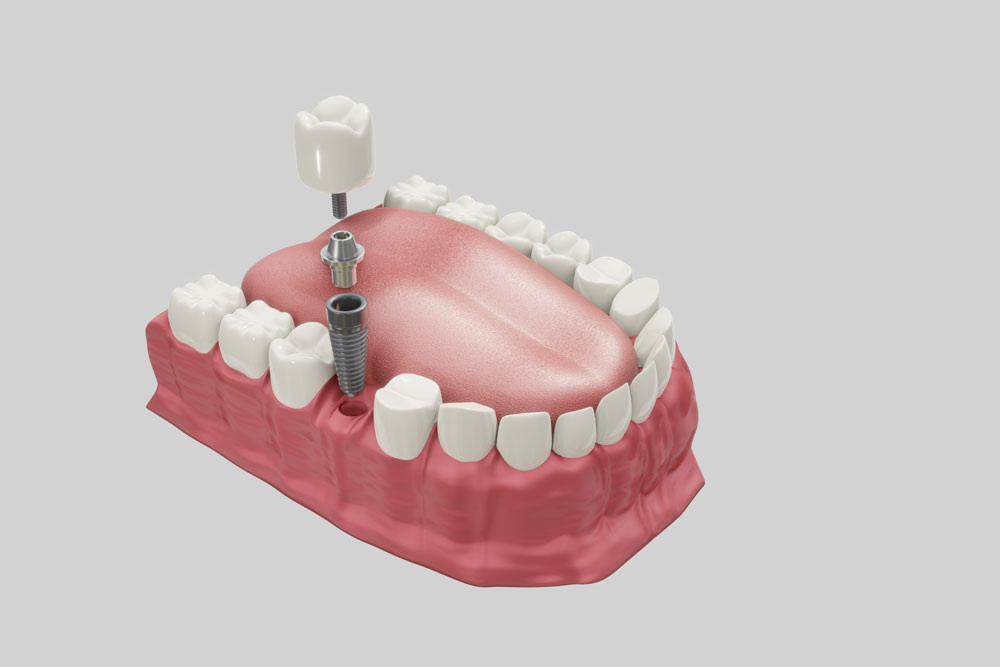 Exploring Dental Implants and Their Benefits Dental Implants