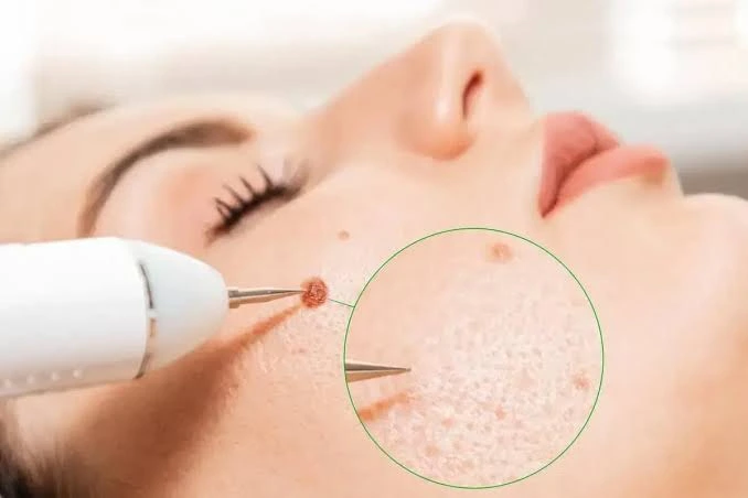 The Link Between Skin Cancer Surgery and Long-Term Skin Health Skin Cancer Surgery